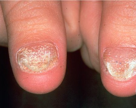 twenty nail dystrophy - pictures, photos