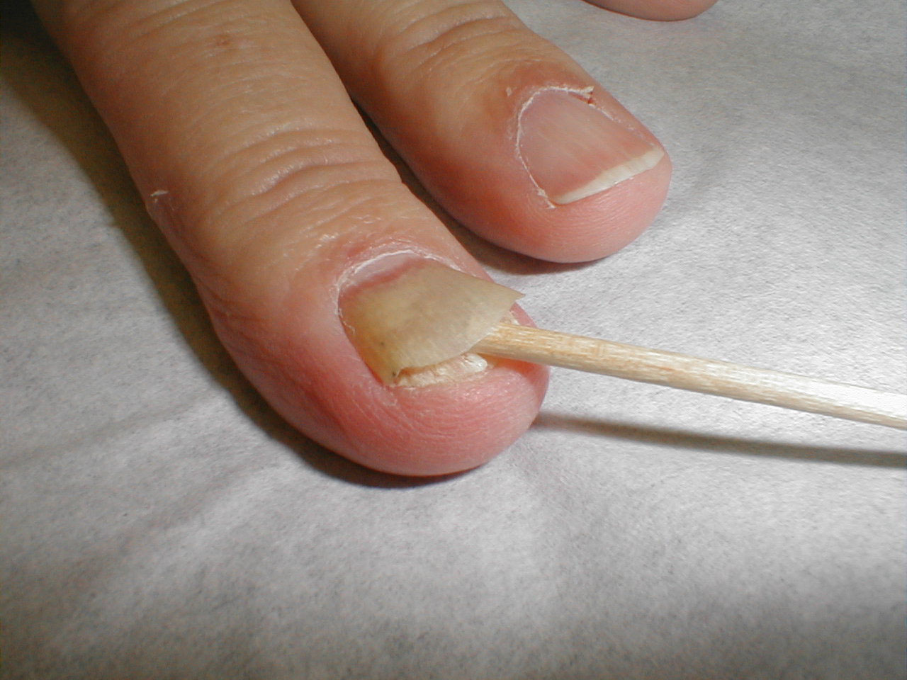 fingernails-ingrown-fingernails-dark-line-fingernail-pain