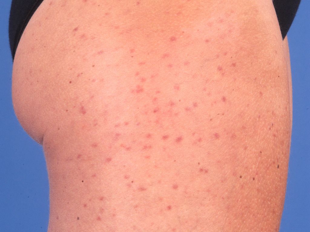 Urticaria Pigmentosa Pictures Photos