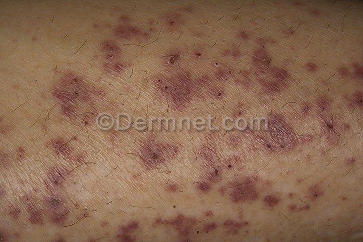 vasculitis of the skin - pictures, photos