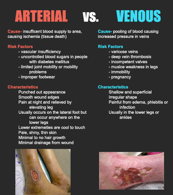 What Is Arterial Insufficiency