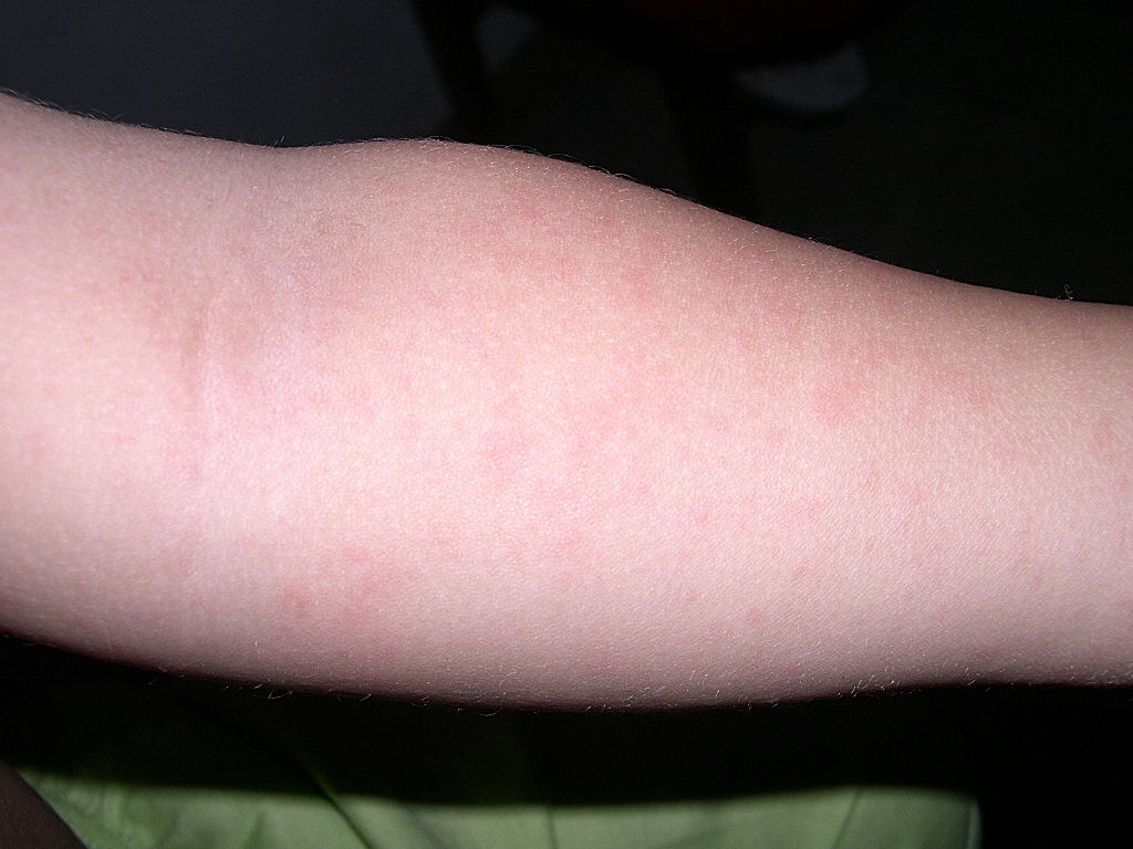 viral exanthem pictures pictures, photos