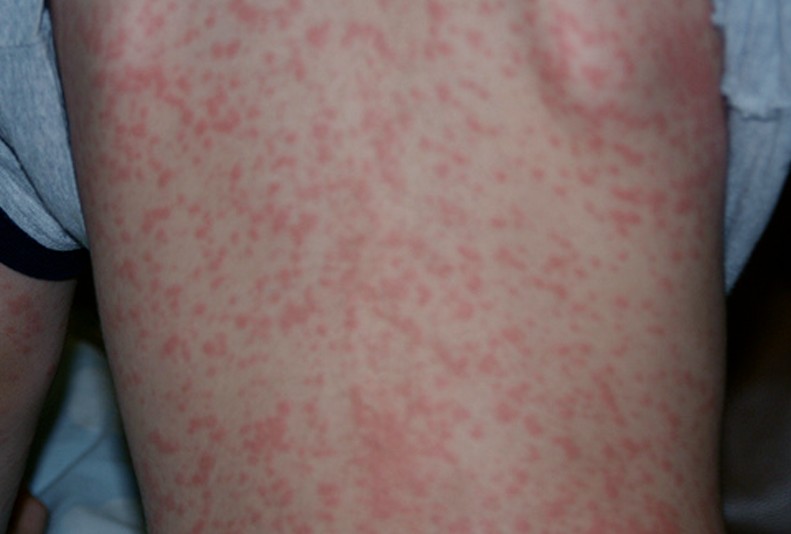 viral skin rash - pictures, photos