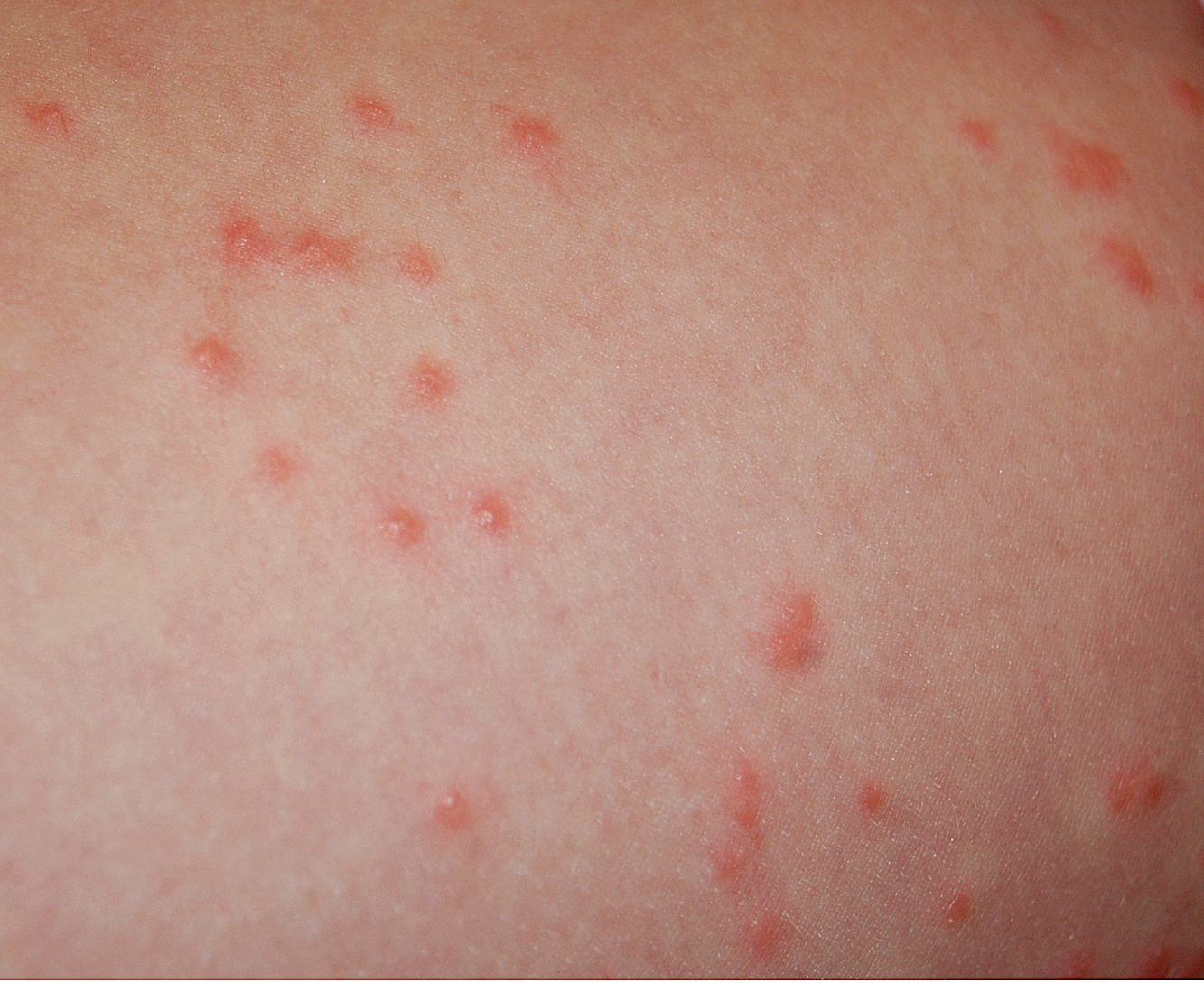 scabies-bite-picture-pictures-photos