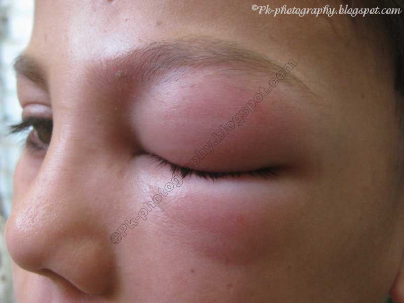 wasp-sting-swelling-pictures-photos