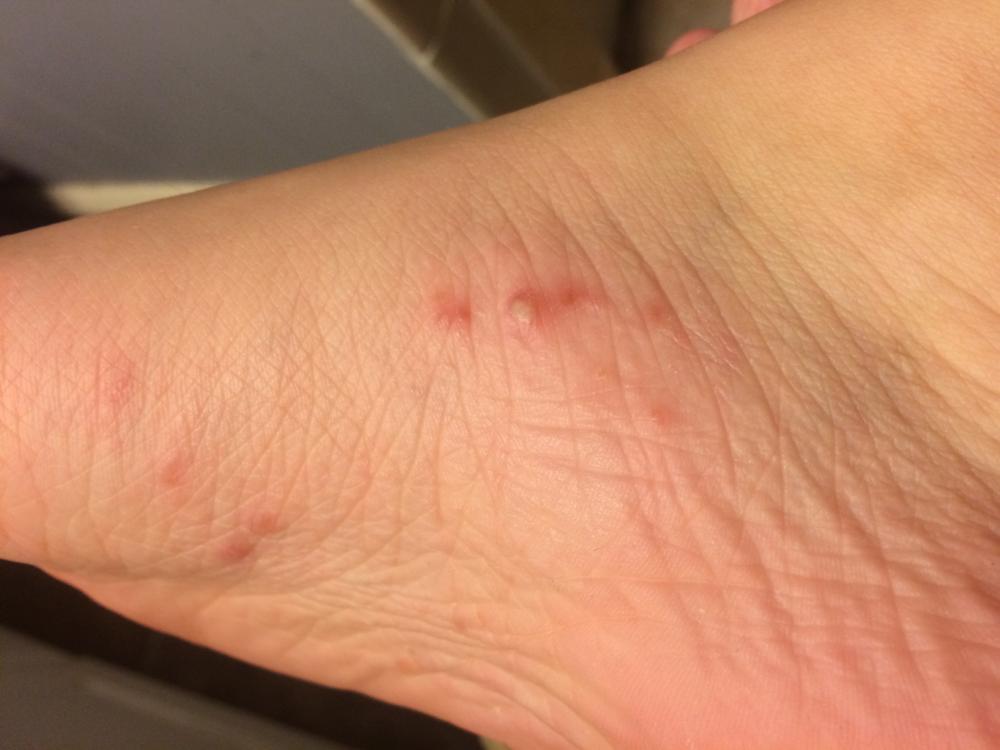 Small Blisters On Bottom Of Foot Pictures Photos