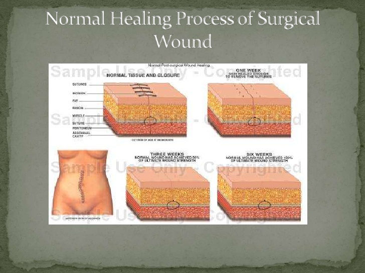 surgical wounds infection pictures, photos