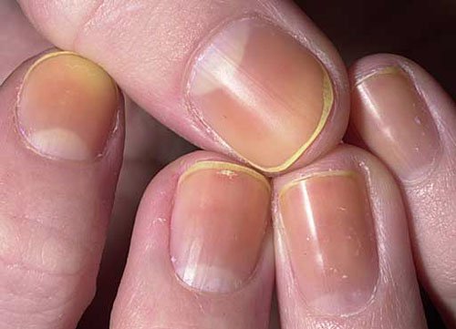 yellow-nail-syndrome-pictures-photos